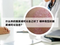 什么样的银屑病可以自己好了 哪种类型的银屑病可以治愈?