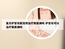 复方炉甘石酚洗剂治疗银屑病吗 炉甘石可以治疗银屑病吗