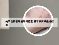 关节性的银屑病如何检查 关节银屑病指标标准