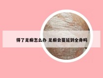 得了足癣怎么办 足癣会蔓延到全身吗