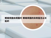 眼睛周围白斑图片 眼睛周围的白斑是怎么引起的