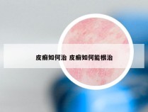 皮癣如何治 皮癣如何能根治