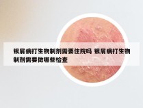 银屑病打生物制剂需要住院吗 银屑病打生物制剂需要做哪些检查