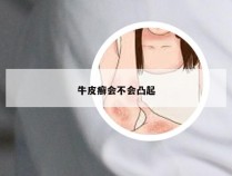 牛皮癣会不会凸起