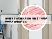 洛阳医银屑病的医院有哪些 洛阳治疗银屑病郑州银屑病研究院地址