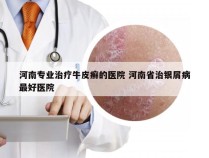 河南专业治疗牛皮癣的医院 河南省治银屑病最好医院