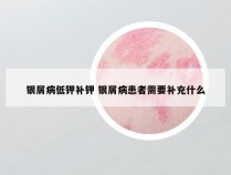 银屑病低钾补钾 银屑病患者需要补充什么