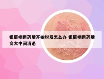 银屑病用药后开始脱发怎么办 银屑病用药后变大中间消退