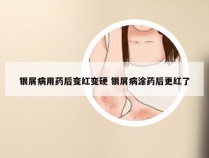 银屑病用药后变红变硬 银屑病涂药后更红了