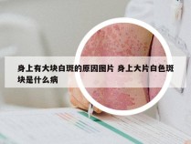 身上有大块白斑的原因图片 身上大片白色斑块是什么病