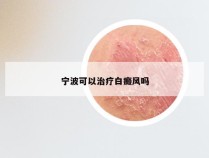 宁波可以治疗白癜风吗