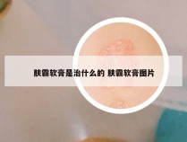 肤霸软膏是治什么的 肤霸软膏图片