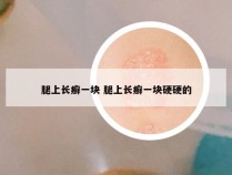 腿上长癣一块 腿上长癣一块硬硬的