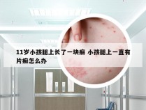 11岁小孩腿上长了一块癣 小孩腿上一直有片癣怎么办