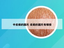 中皮癣的图片 皮癣的图片有哪些