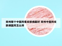 郑州那个中医院看皮肤病最好 郑州中医院皮肤病医院怎么样