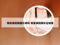 银屑病初期图片痒吗 银屑病初期长在哪里