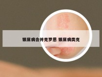 银屑病合并克罗恩 银屑病类克