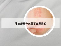 牛皮癣用什么药不含激素的