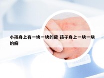 小孩身上有一块一块的藓 孩子身上一块一块的癣