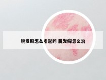 脱发癣怎么引起的 脱发癣怎么治