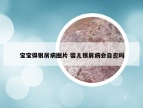 宝宝得银屑病图片 婴儿银屑病会自愈吗