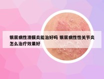 银屑病性滑膜炎能治好吗 银屑病性性关节炎怎么治疗效果好