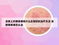 皮肤上的银屑病有什么比较好的治疗方法 皮肤银屑病怎么治