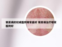 银屑病的权威医院哪家最好 银屑病治疗哪家医院好