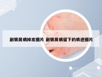 副银屑病掉皮图片 副银屑病留下的痕迹图片