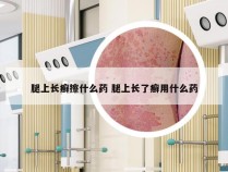 腿上长癣擦什么药 腿上长了癣用什么药