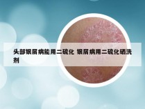 头部银屑病能用二硫化 银屑病用二硫化硒洗剂