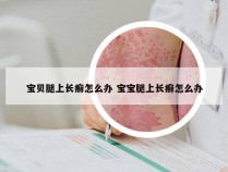 宝贝腿上长癣怎么办 宝宝腿上长癣怎么办