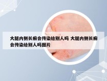 大腿内侧长癣会传染给别人吗 大腿内侧长癣会传染给别人吗图片