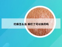 烂癣怎么治 癣烂了可以抹药吗