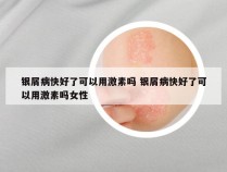 银屑病快好了可以用激素吗 银屑病快好了可以用激素吗女性