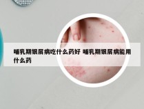 哺乳期银屑病吃什么药好 哺乳期银屑病能用什么药