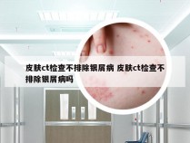 皮肤ct检查不排除银屑病 皮肤ct检查不排除银屑病吗