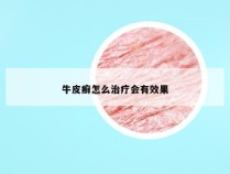 牛皮癣怎么治疗会有效果