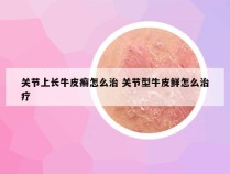 关节上长牛皮癣怎么治 关节型牛皮鲜怎么治疗