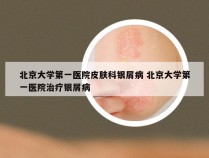 北京大学第一医院皮肤科银屑病 北京大学第一医院治疗银屑病