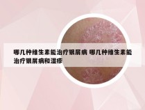 哪几种维生素能治疗银屑病 哪几种维生素能治疗银屑病和湿疹