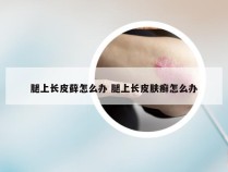 腿上长皮藓怎么办 腿上长皮肤癣怎么办