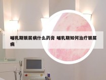 哺乳期银屑病什么药膏 哺乳期如何治疗银屑病