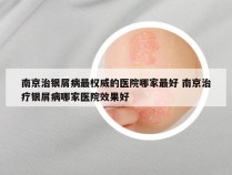 南京治银屑病最权威的医院哪家最好 南京治疗银屑病哪家医院效果好