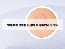 银销疲癣是怎样引起的 银宵癣的治疗方法