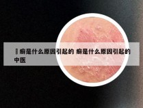 菭癣是什么原因引起的 癣是什么原因引起的中医