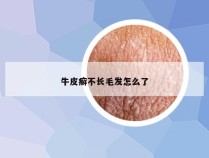 牛皮癣不长毛发怎么了