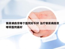 银屑病南京哪个医院好不好 治疗银屑病南京哪家医院最好