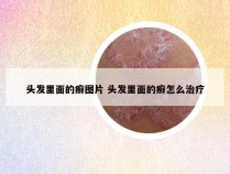 头发里面的癣图片 头发里面的癣怎么治疗